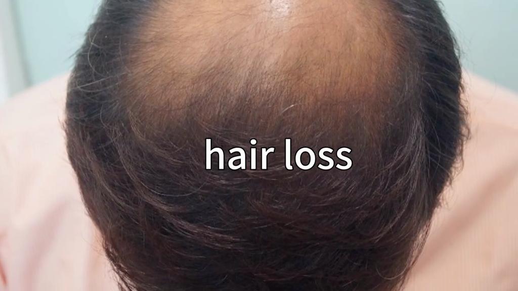 PURC Produtos de crescimento rápido do cabelo de biotina para homens e mulheres colágeno anti perda de cabelo óleo recrescimento do cabelo tratamento do couro cabeludo cuidados com os cabelos