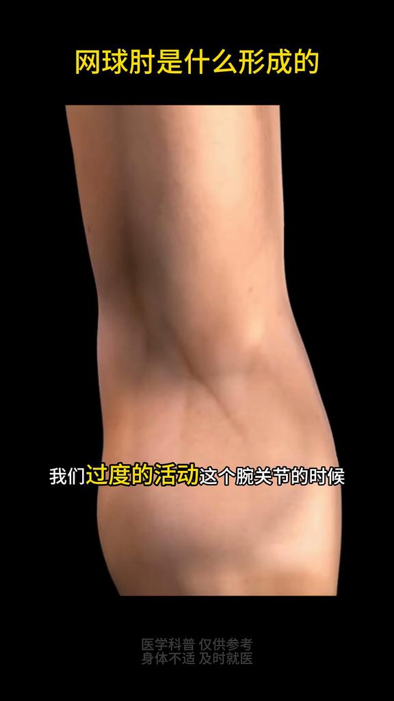 Tennis elbow special plaster humerus lateral epicondylitis gel arm elbow joint pain strain official genuine import patch