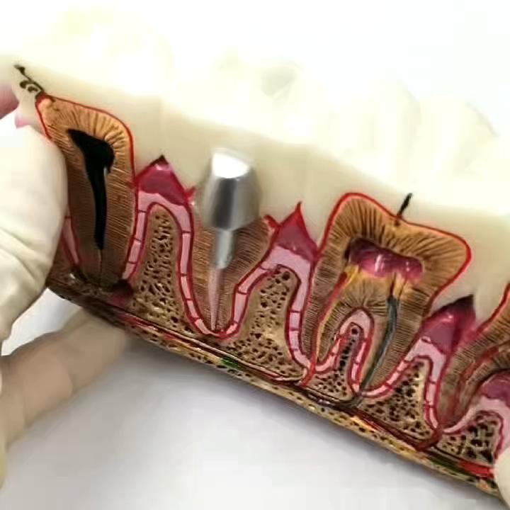 1 Pc Dental Teeth Common Pathologies Model Teaching Model Tooth Dentist for Medical Science Teaching Dental Communication Model