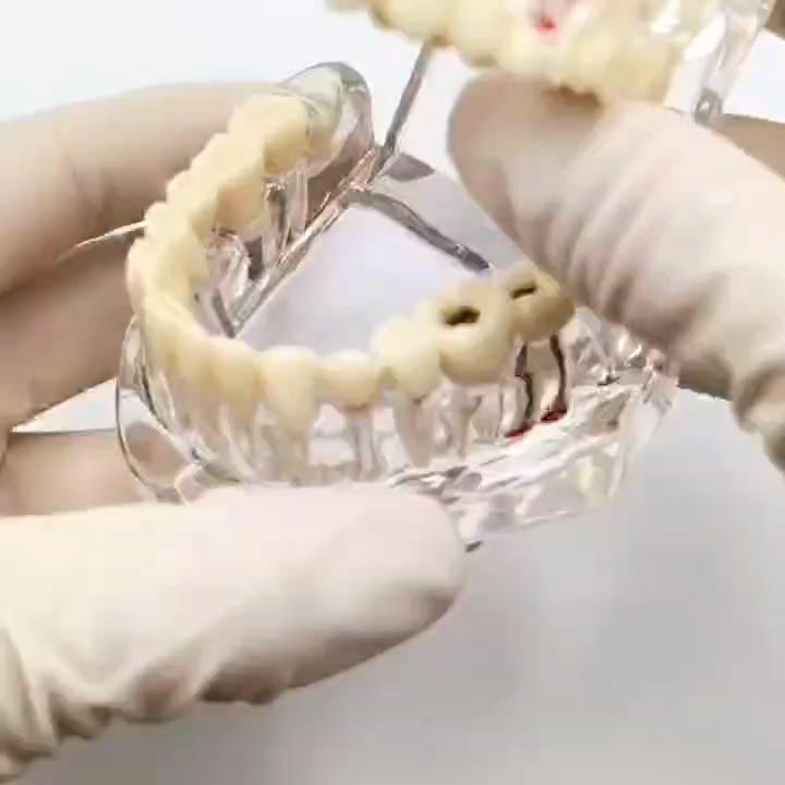 1 kus Model zubů pro onemocnění zubního implantátu s obnovou můstkového zubu Zubař pro lékařskou vědu, studium zubních onemocnění