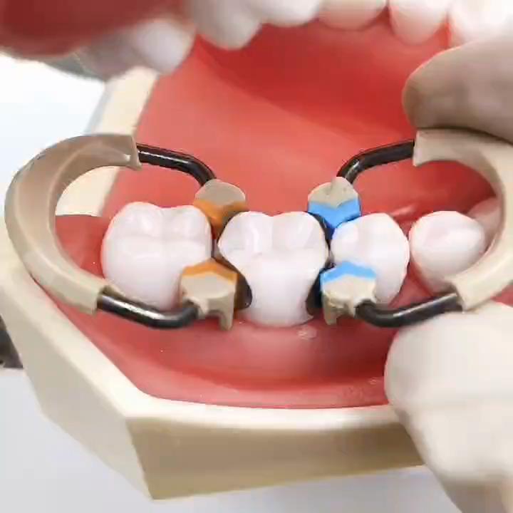 1 Piece Dental Matrix System Set Contoured Matrices Clip Ring Matrix Bands Wedge Plastic Kit Dentistry Instrument Tool