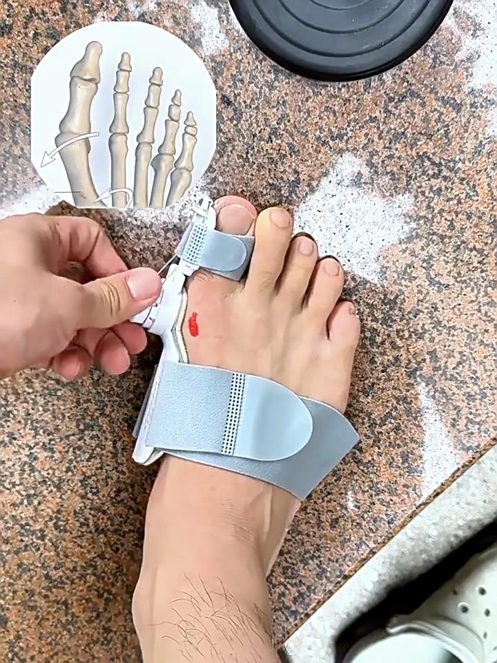 Device for correcting hallux valgus