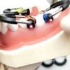 Dental Sectional Matrices Clip Matrix System NITI and Peek Material Ring Matrix Bands Dentistry Instrument Tool