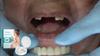 Oralhoe Регулируемые защелкивающиеся зубные протезы Удобные регулируемые зубные протезы подходят для жевания зубов Power Fit