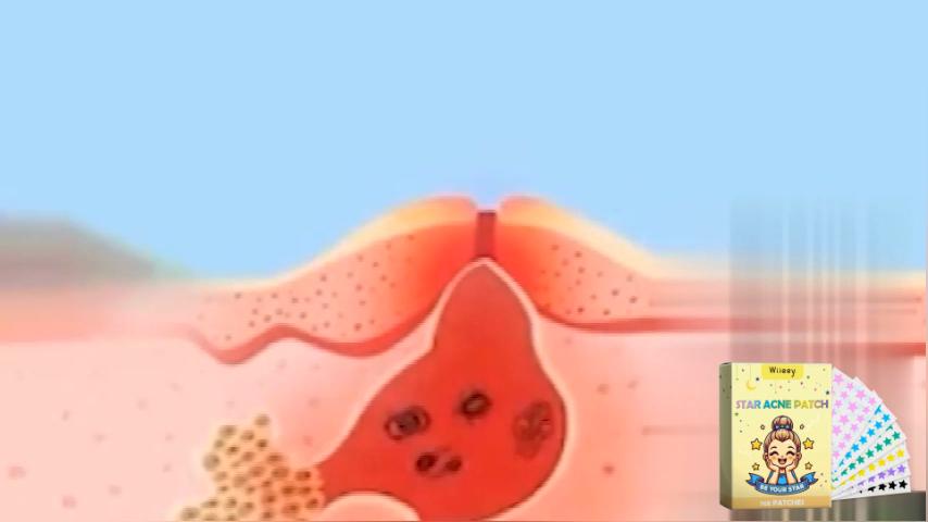 Wiieey Star Pimple Patch Fade Down Pimple Pimple Marks Clean Face Closed Acne Portable Cartoon Pimple Patch