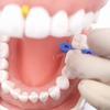 Dental Transparent Sectional Contoured Matrices Matrix Polyester Matrice  for Anterior and Posterior Teeth