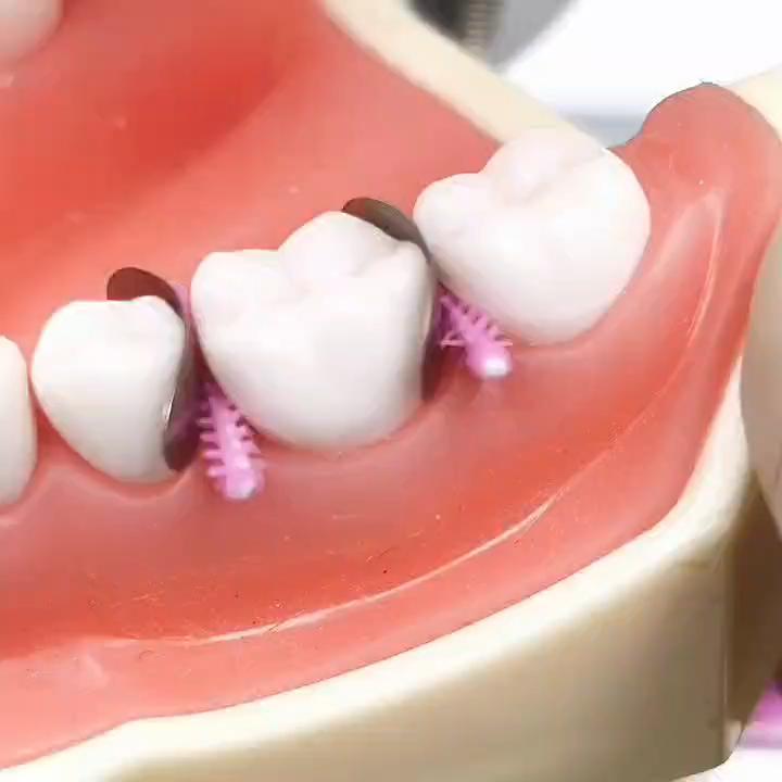 1 Pack or 2 Packs Disposable Dental Adaptive Silicone Interdental Wedge Medical Silicone Materials Dental Matrice Matrix Wedges